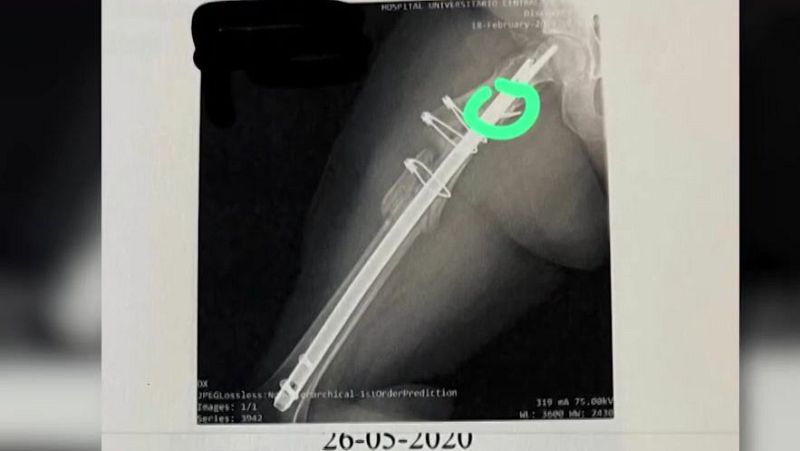 Se olvidan una broca en mi pierna - Mañaneros 360 | Ver