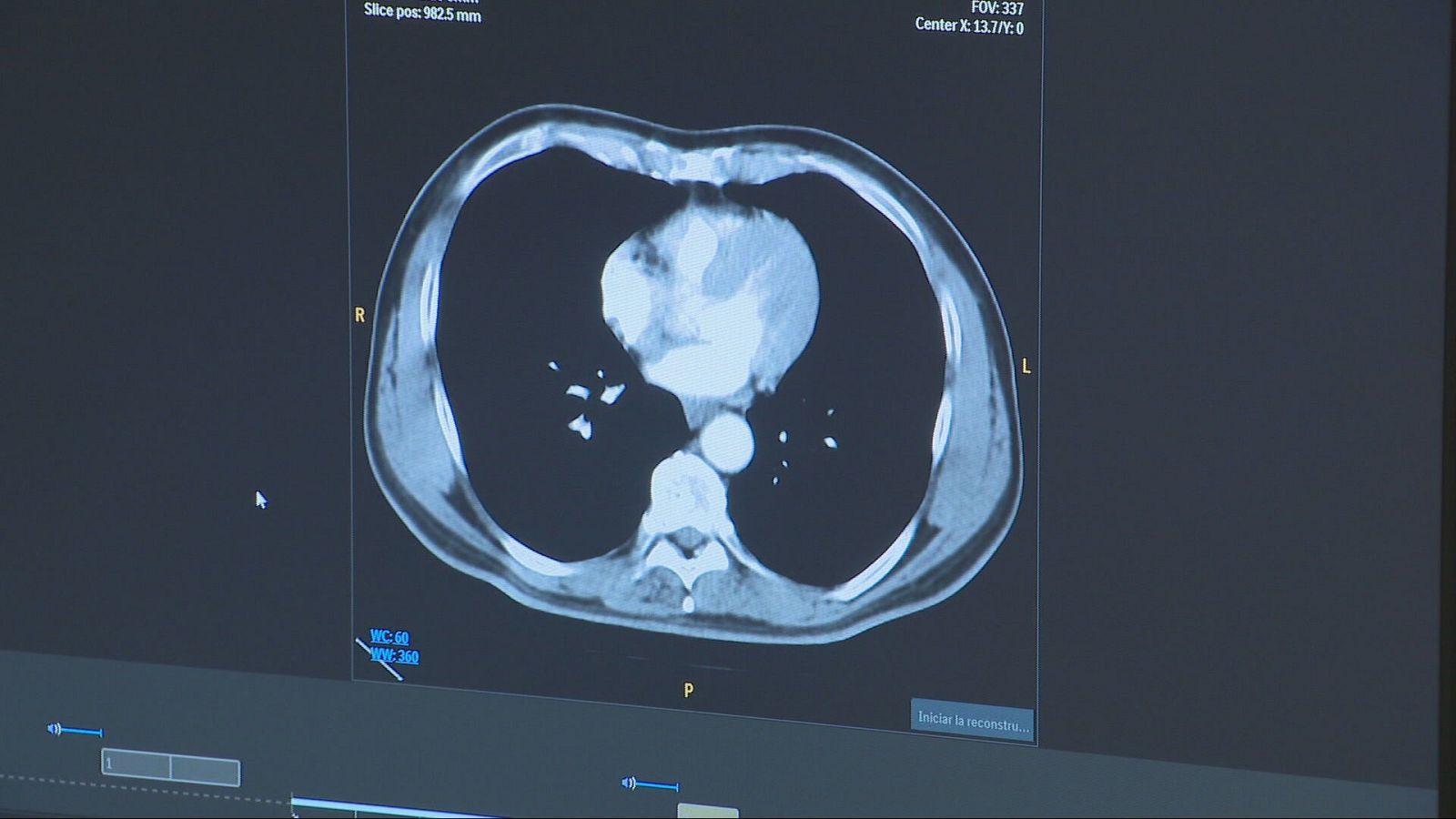 Una tècnica pionera millora la supervivència dels pacients amb càncer de pulmó