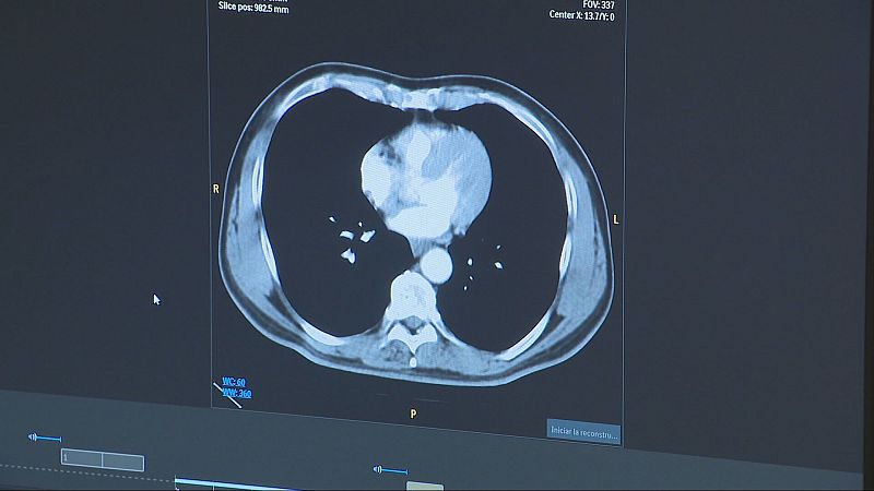 Una tècnica pionera millora la supervivència dels pacients amb càncer de pulmó