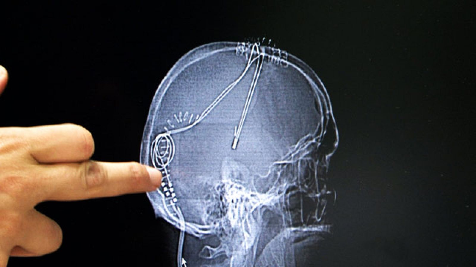 Comando actualidad - Milagro médico - Operación de electrodos - ver ahora