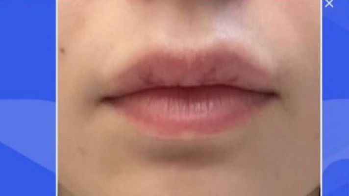 Directo al grano - Aumentos de labios ilegales