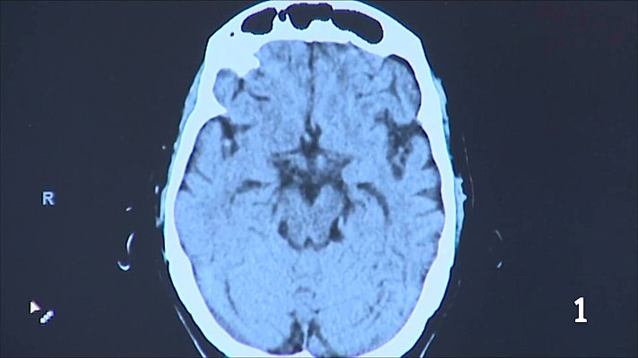 L'Informatiu - Troben un fàrmac per reduir les migranyes en infants i adolescents