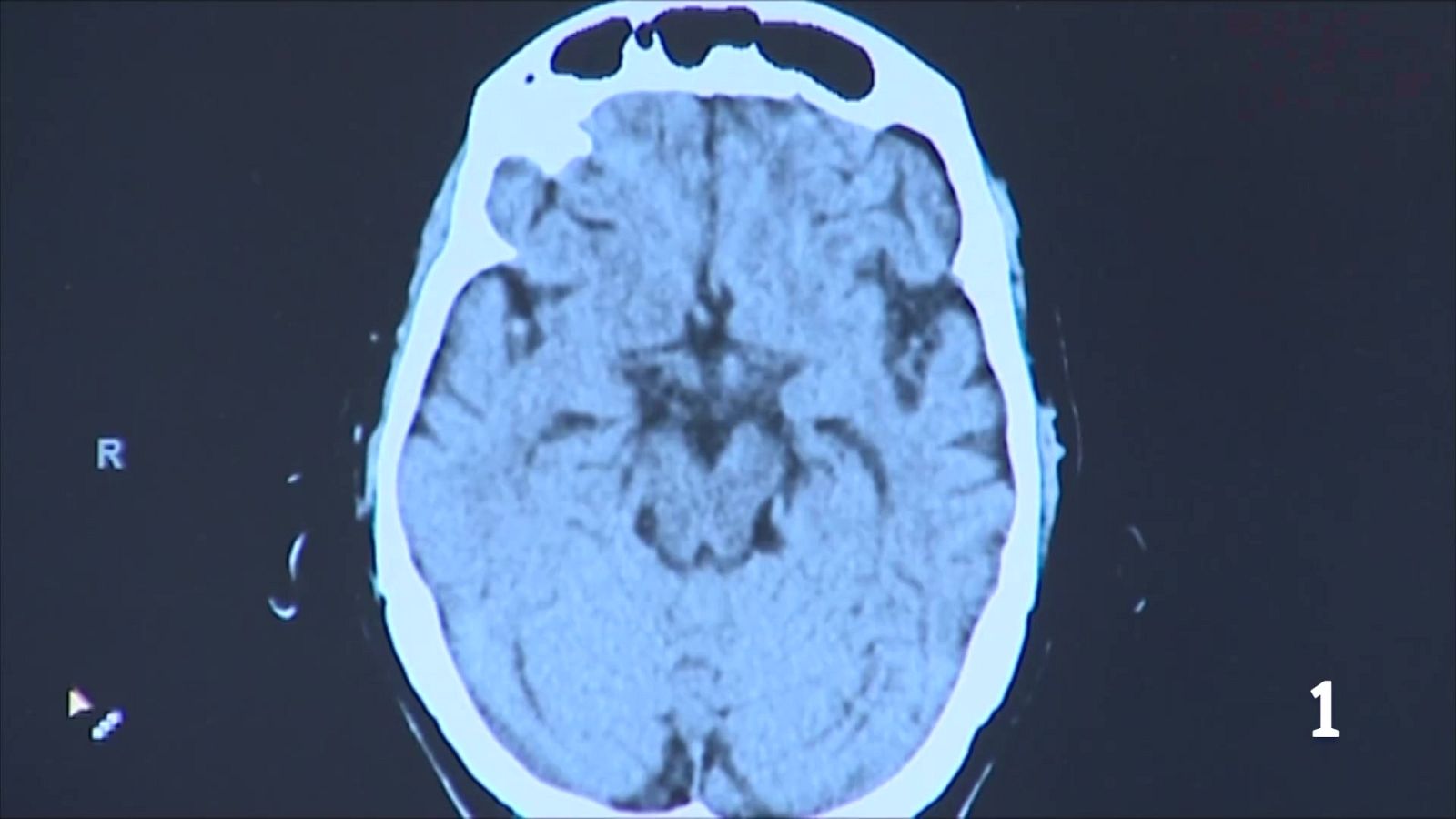 Troben un fàrmac per reduir les migranyes en infants i adolescents