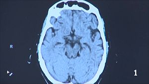 Troben un f�rmac per reduir les migranyes en infants i adolescents