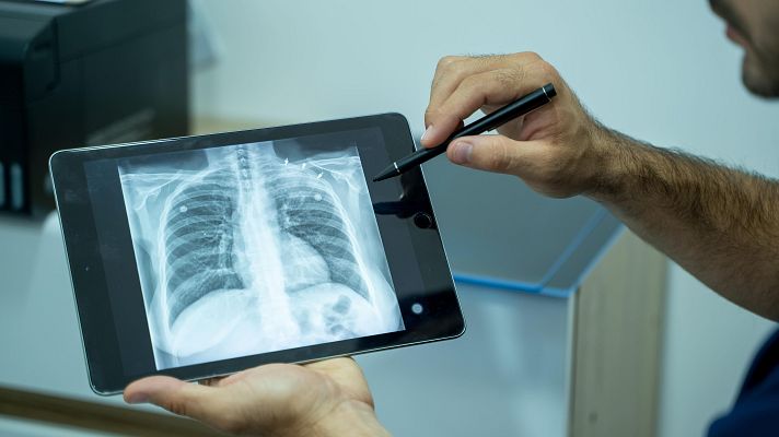 Telediario 1 - Aumentan los casos de tuberculosis en España un 8,3%