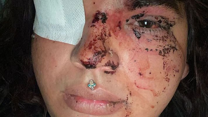 Telediario 2 - Una mujer ha denunciado haber sufrido una brutal paliza por ser trans en León