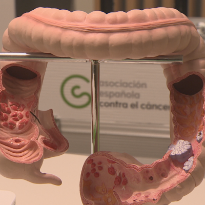 Telenorte - País Vasco - Detectar el cáncer de colon a tiempo: la clave que salva 9 de cada 10 vidas