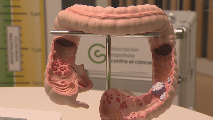 Telenorte - País Vasco - Detectar el cáncer de colon a tiempo: la clave que salva 9 de cada 10 vidas