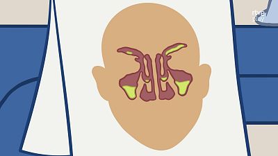 Croco Doc - Sinusitis - Croco Doc | Ver