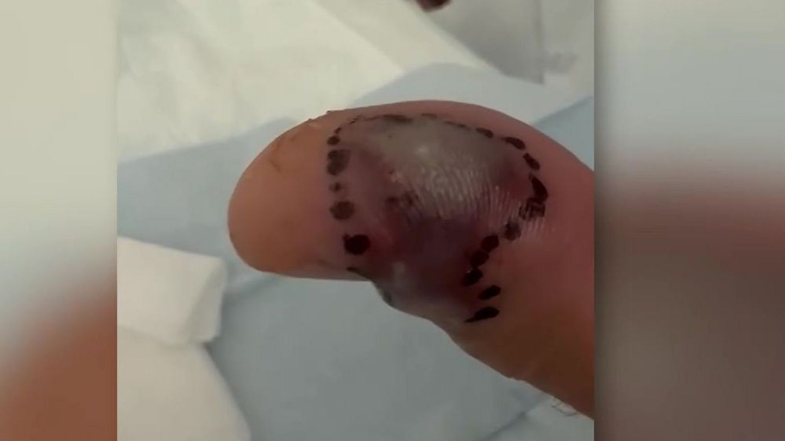 "Casi pierdo el brazo por una araña" - Mañaneros 360 | Ver