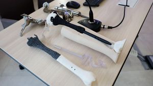 El Gregorio Mara��n salva la pierna a un hombre con la primera pr�tesis personalizada de metamaterial del mundo