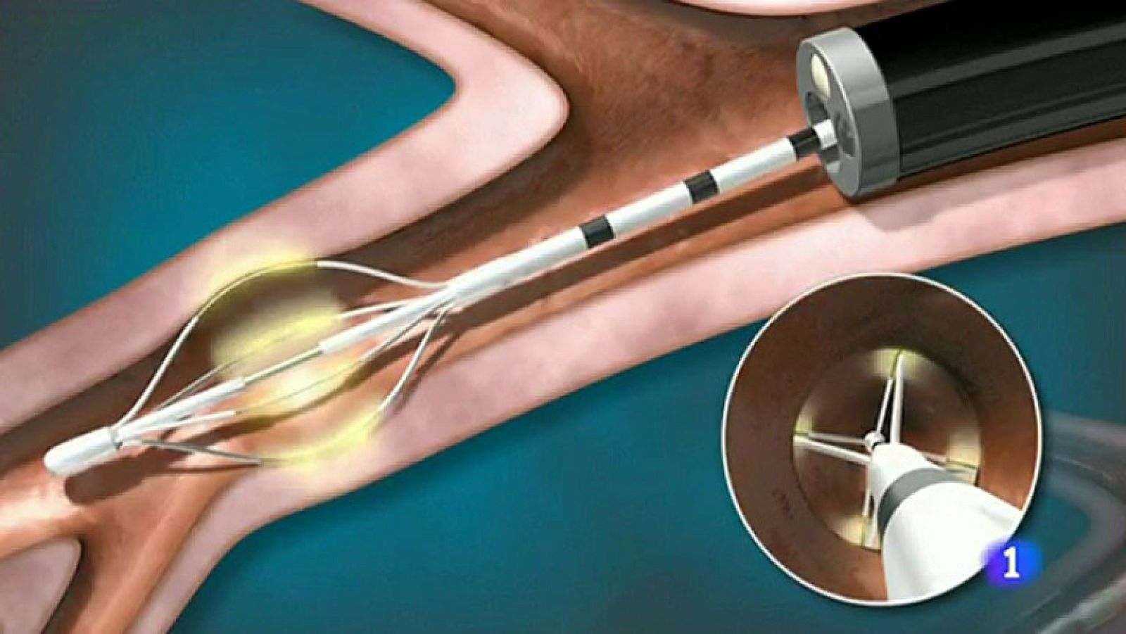 Se crea un nuevo tratamiento que mejora los síntomas en enfermos con asma grave