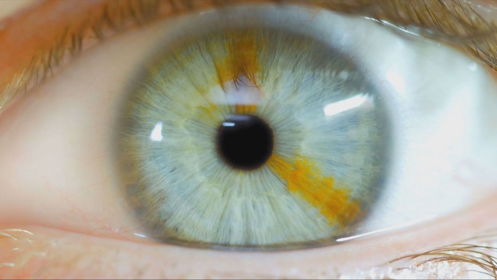 Plano macro de un ojo humano con iris azul claro y heterocromía sectorial en tonos ámbar, mostrando gran detalle en la pupila y las pestañas.