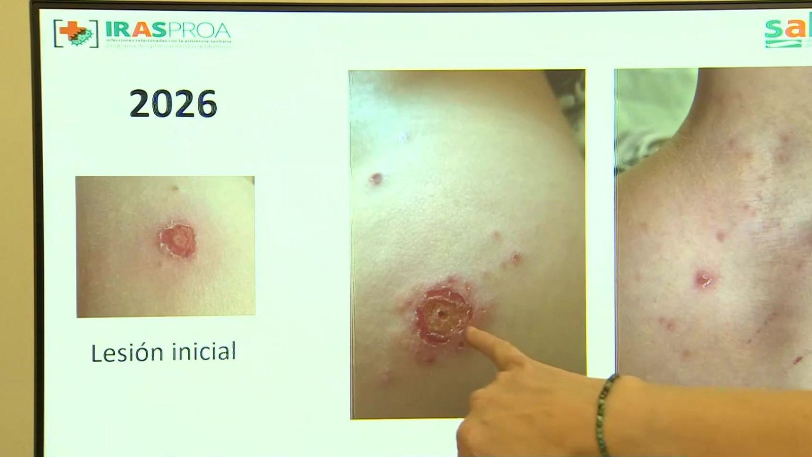 Monitor con una presentación médica sobre dermatología que muestra fotografías clínicas de lesiones cutáneas y una persona señalando la pantalla.