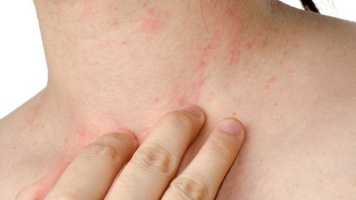 La mañana - Cómo cuidar la piel delicada