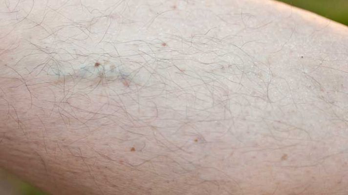 La mañana - Varices y mala circulación