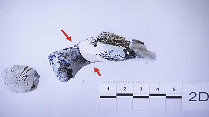 Telediario 1 - Declaración del forense