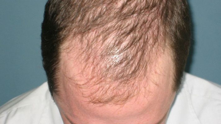 Telediario 1 - Solución a la calvicie