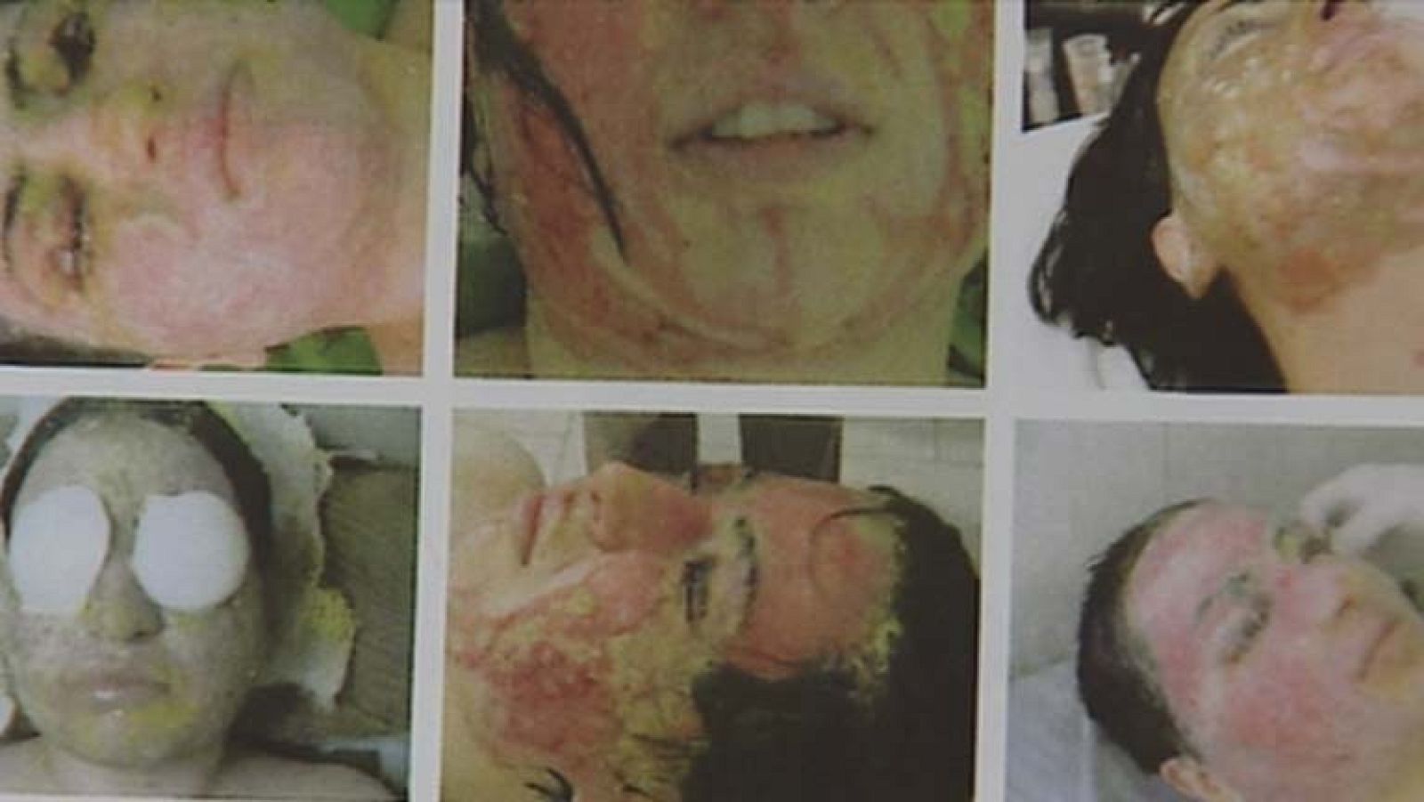 India lanza una campaña contra los ataques con ácido a mujeres