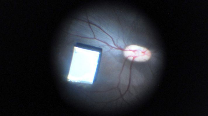 Telediario 1 - Científicos israelíes desarrollan una nano retina, un chip que devuelve parcialmente la vista