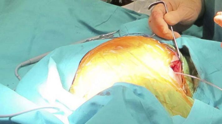 Telediario 1 - Trasplantes de corazón