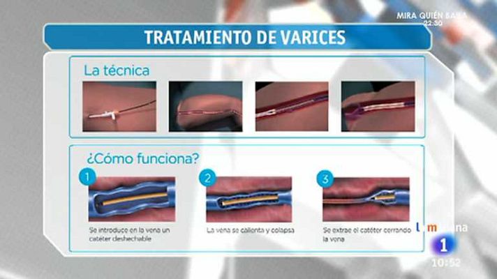 La mañana - Saber vivir -  Varices y mala circulación
