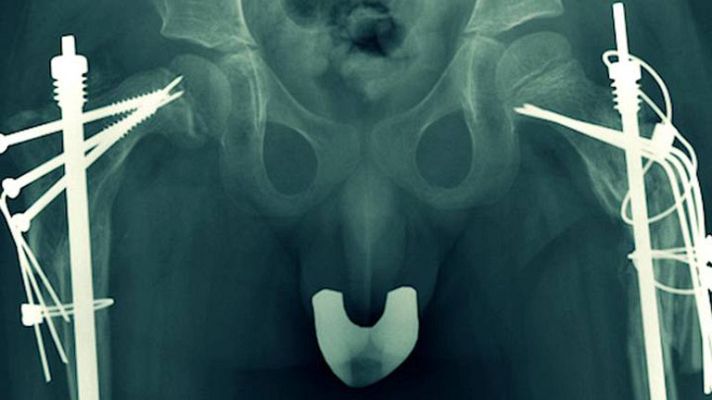 Documentos TV - Documentos TV - Avance: 'Frágil. Un camino de cristal'