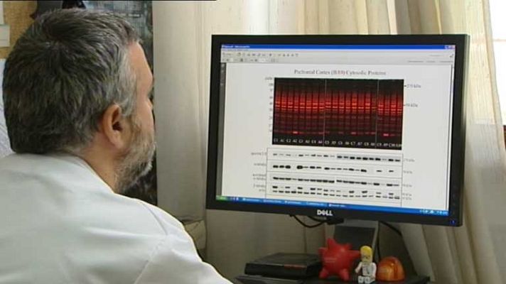 Telediario 1 - El consumo abusivo de alcohol provoca daños en el cerebro