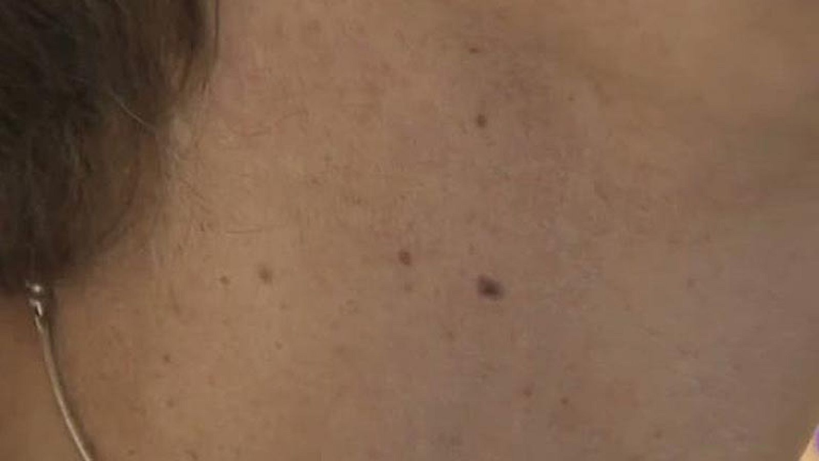 El Centro Nacional de Investigaciones Oncológicas descubre más de 40 genes del melanoma