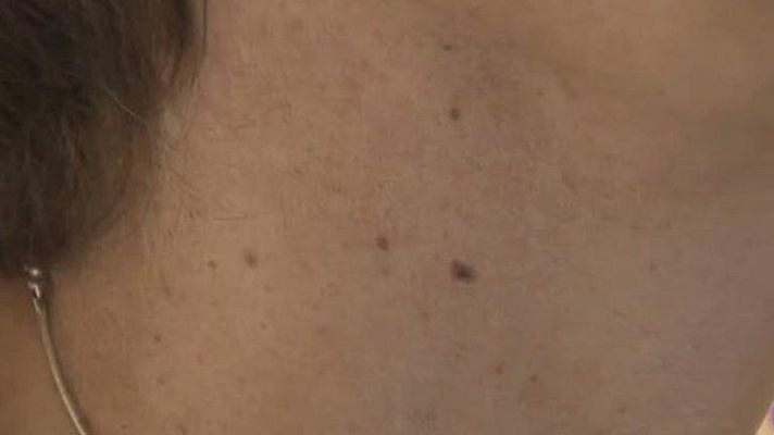 Telediario 1 - Más de 3.000 nuevos casos de melanoma al año en España