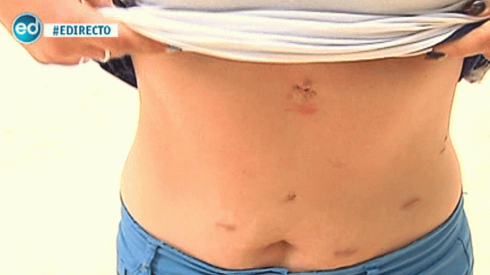 España Directo - Denuncian secuelas tras implantarse unas bandas gástricas