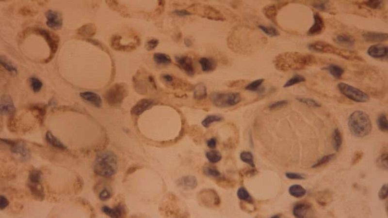 Investigación para alargar la vida de algunos pacientes con cáncer
