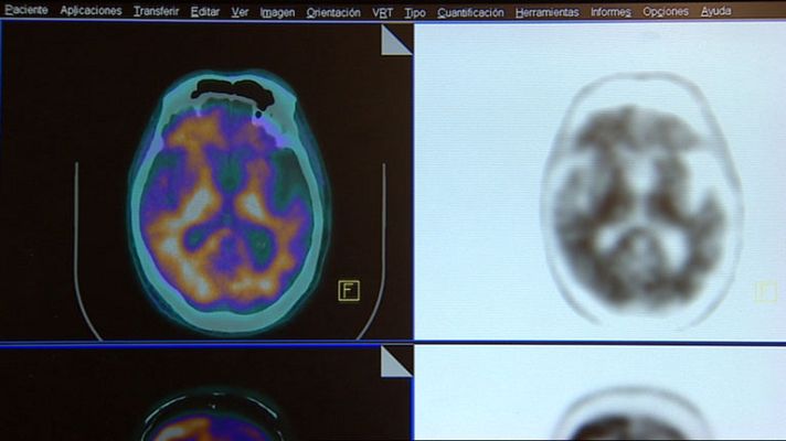 Telediario 1 - Los casos de Alzheimer aparecen cada vez más temprano
