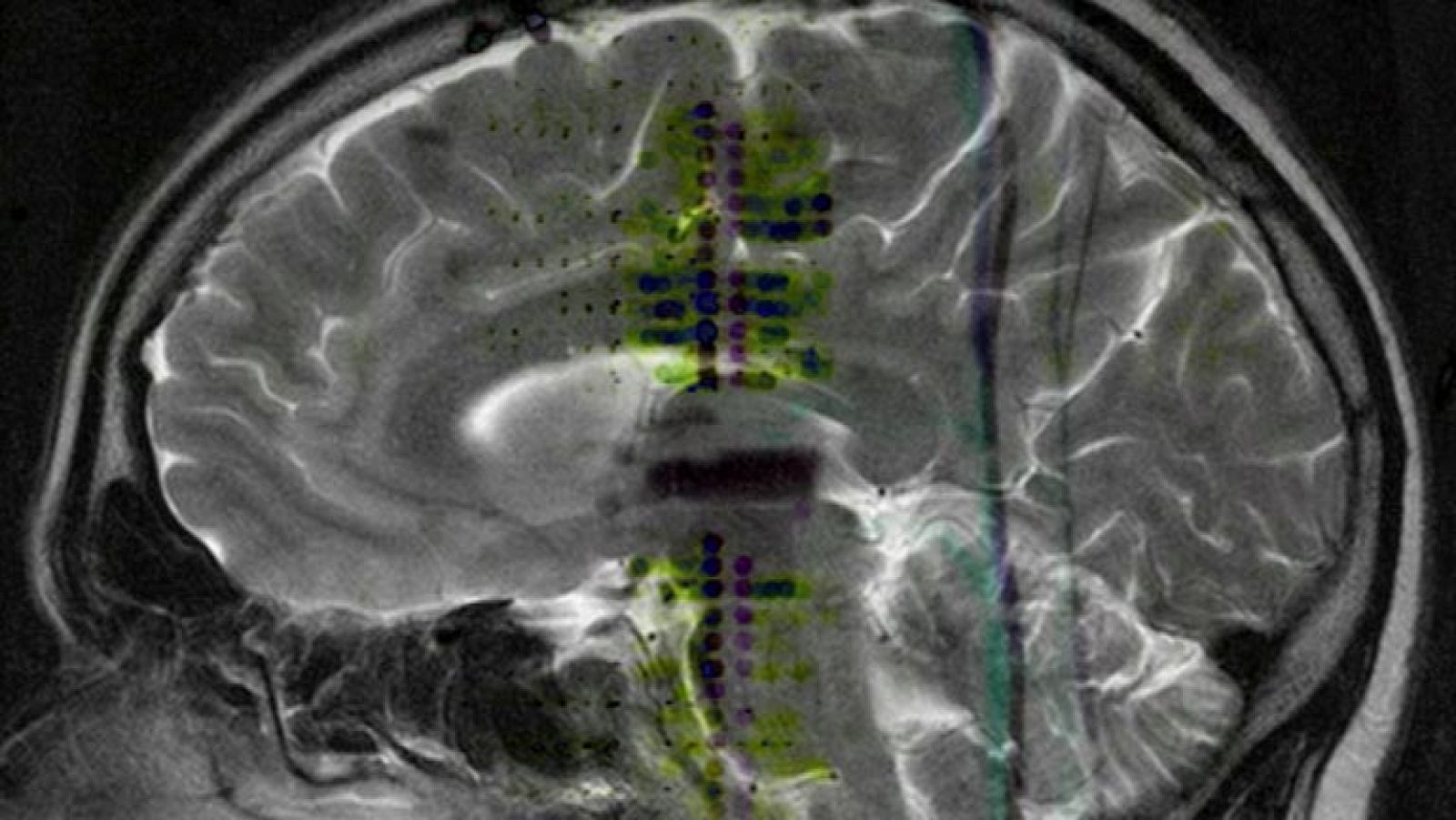 La migraña es la cuarta enfermedad que causa más discapacidad