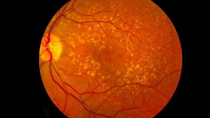 Telediario 1 - Un trasplante de células madre logra regenerar la visión en pacientes con ceguera