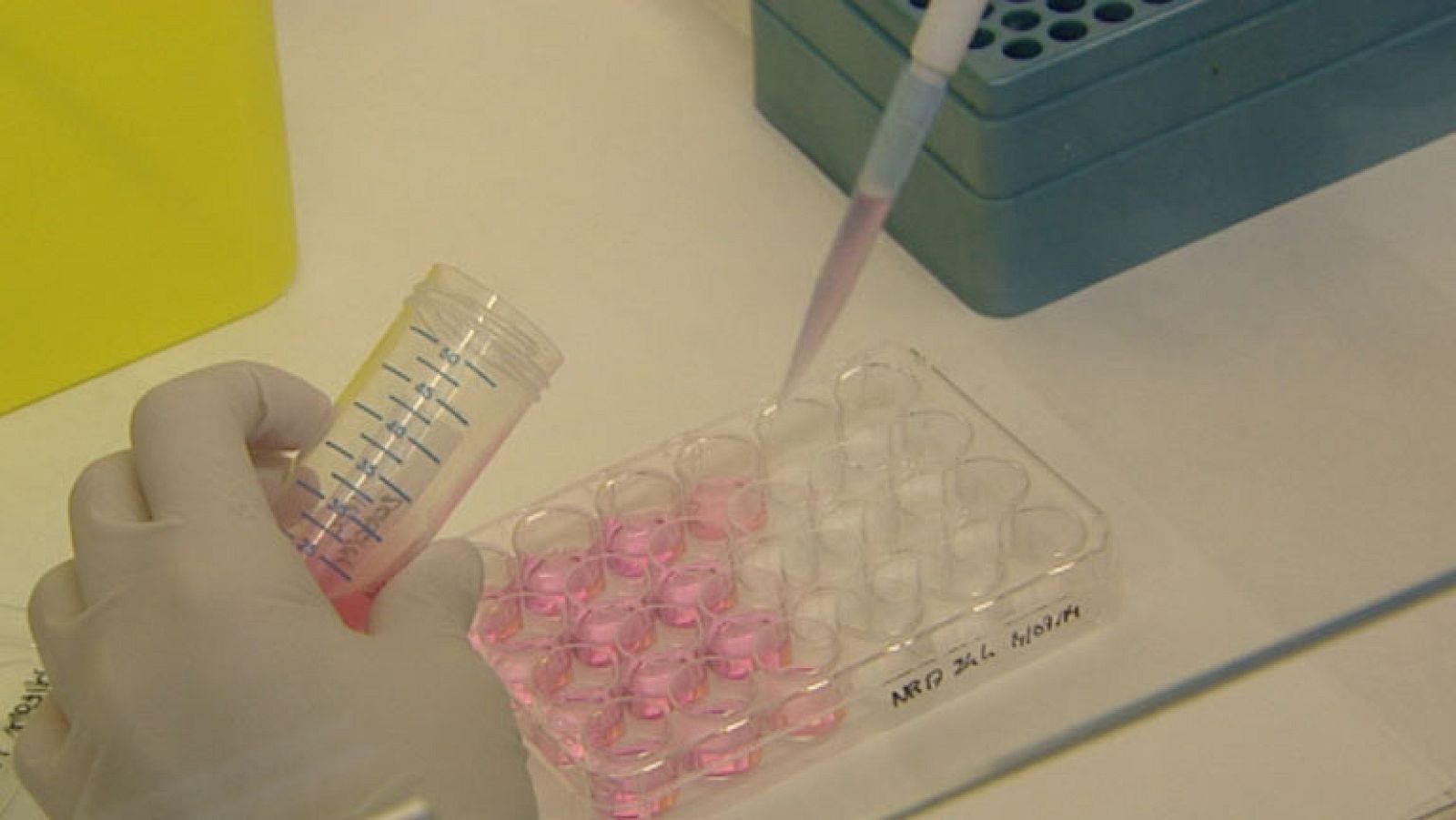 Un suplemento alimenticio podría prevenir el desarrollo de la tuberculosis