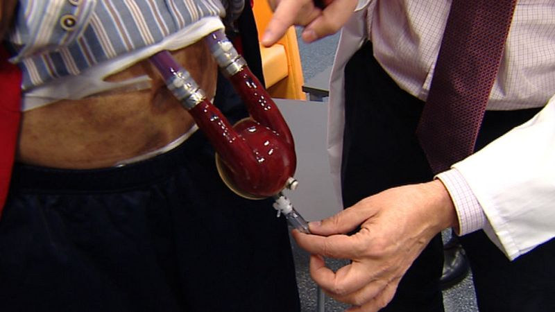 Corazones artificiales que dan una segunda oportunidad