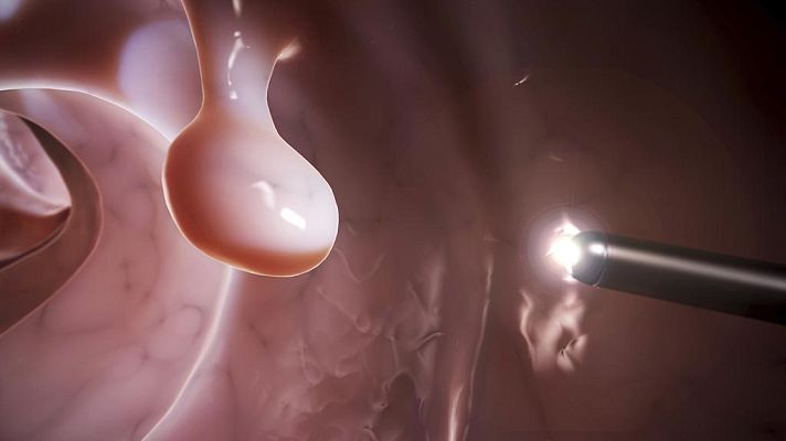 Telediario 1 - En 2014 se registraron 240.000 nuevos casos de cáncer en España