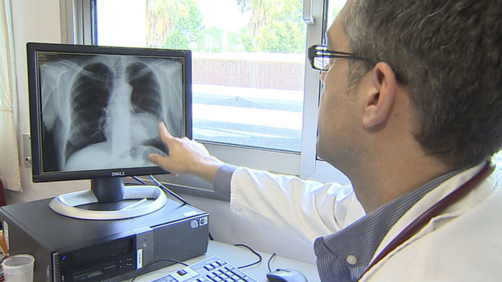 18.000 personas mueren cada año en España de cáncer de pulmón