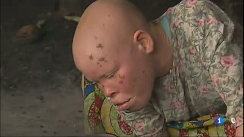 Dermtaòlegs catalans aprofiten les vacances per lluitar contra l'albinisme a l'Àfrica