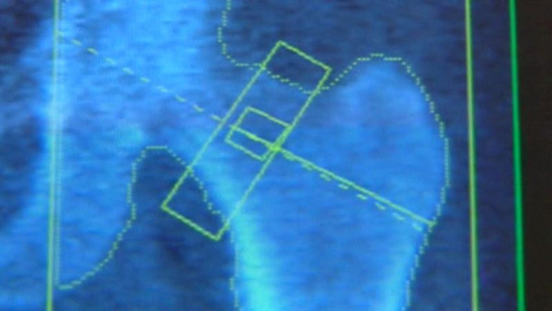 La empresa Traiber está siendo investigada por vender prótesis caducadas que se implantaban a pacientes