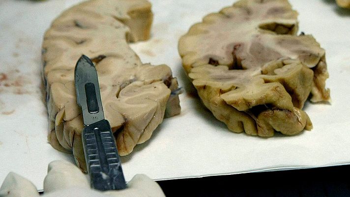 Telediario 1 - Una proteína asociada al alzheimer podría transferirse por contaminación del material quirúrgico