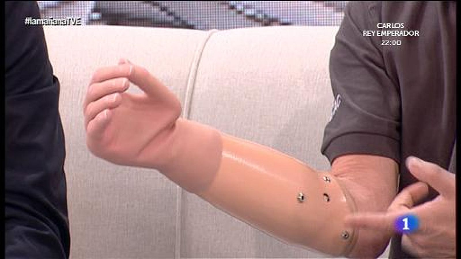 La mañana - ¿Cómo se vive con una mano biónica?