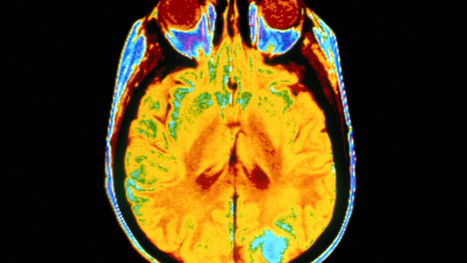 Saber vivir - El riego cerebral y sus riesgos