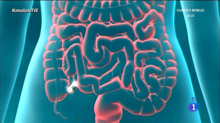 La mañana - Evitemos el cáncer intestinal