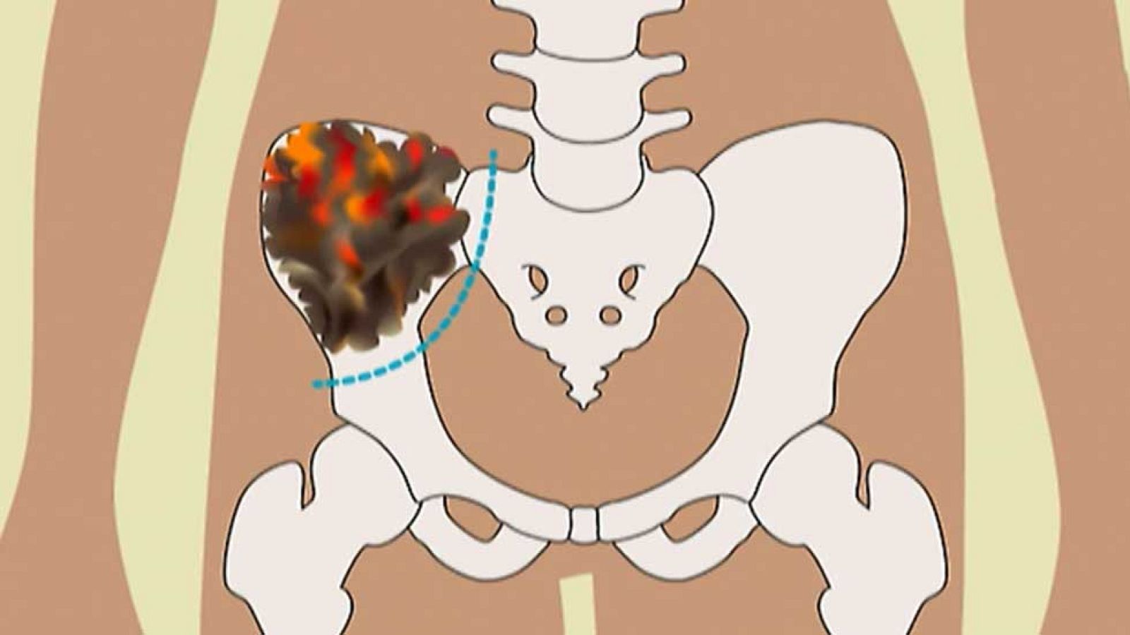 Médicos del Hospital Sant Joan de Déu reconstruyen con éxito la pelvis de una niña de 11 años