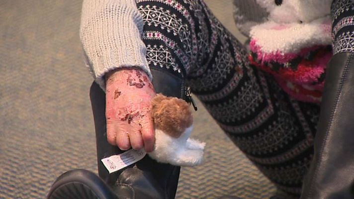 Telediario 1 - Los médicos esperan que en una década haya una terapia con células madre para los enfermos con 'piel de mariposa'