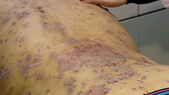 Telediario 1 - Más de un millón de españoles tiene psoriasis