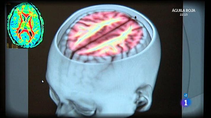 La mañana - Ictus y riesgos cerebrales