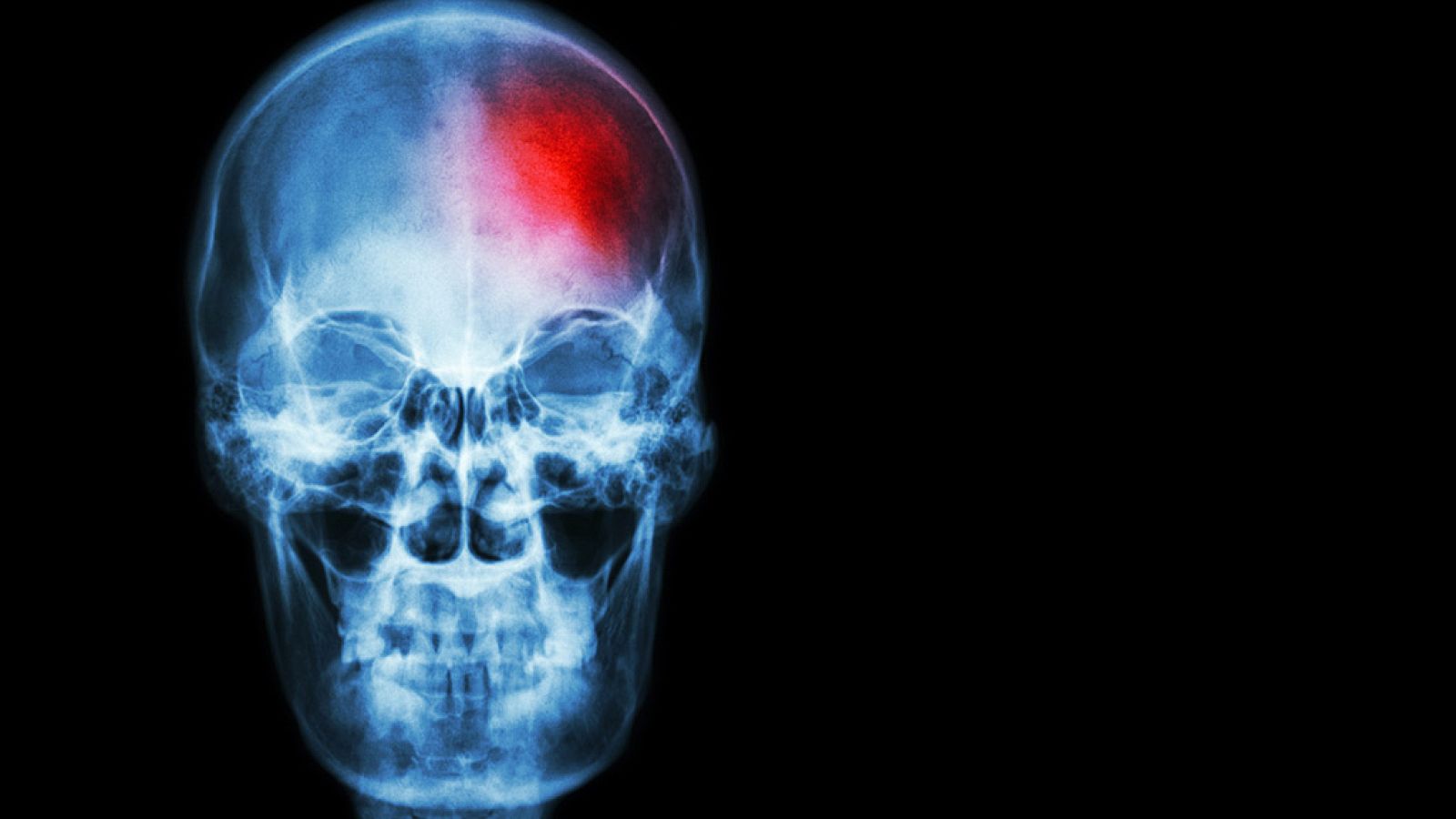 La rapidez en la primera atención ante un ictus es clave para reducir sus secuelas